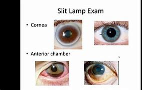 Image result for Slit Lamp Exam