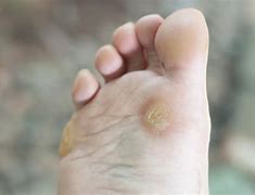 Image result for Warts 101