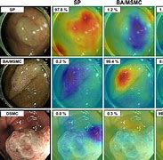 Image result for Colon Polyp Size Chart