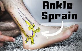 Image result for Rolled Ankle Injury