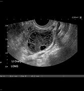Image result for Complex Ovarian Cyst On Ultrasound