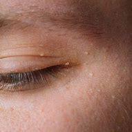 Image result for Wart Under Eye