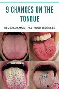 Image result for Tongue Ailments