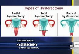 Image result for Hysterectomy