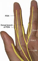 Image result for Man Nerve Hand Before After