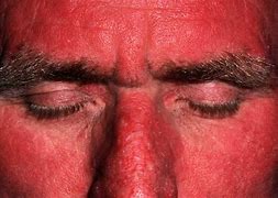 Image result for The Scariest Skin Eruptions