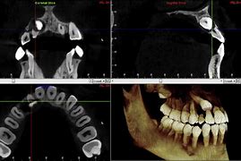 Image result for Lateral Incisor and External Resorption