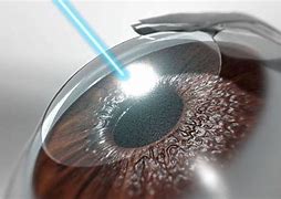 Image result for Custom Lasik Eye Surgery