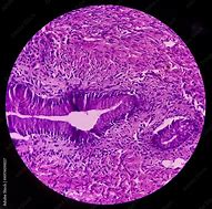 Image result for Ovarian Cyst Baby