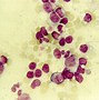 Image result for Erythrocyte P Antigen and Parvovirus B19