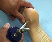 Image result for Cryotherapy Wart Removal