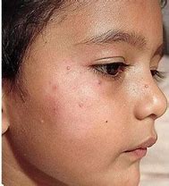 Image result for Wart Children