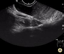 Image result for IRM Chist Dermoid Ovarian