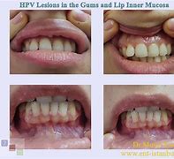 Image result for Lip Papilloma