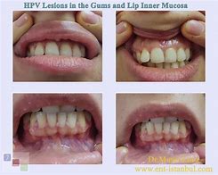 Image result for HPV On Back of Tongue