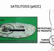 Image result for 2 Cm Tumor Size Of