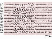 Image result for Epileptiform Discharges