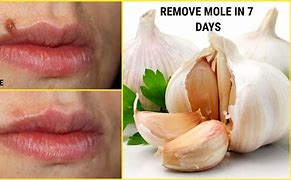 Image result for Natural Mole Removal