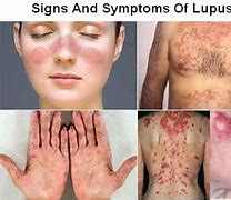 Image result for Loopos Disease