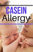 Image result for Casein Allergy