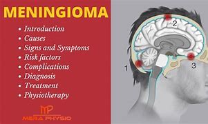 Image result for Meningioma Symptoms