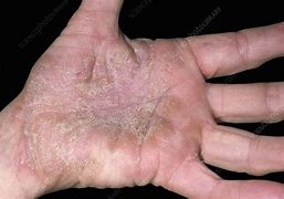 Image result for Palmar Keratosis