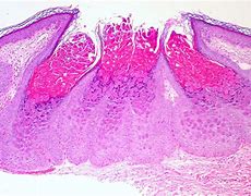 Image result for Molluscum Contagiosum Black