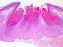Image result for Molluscum Contagiosum as an STD