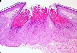 Image result for Molluscum Contagiosum Virus Cell Anatomy