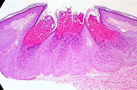 Image result for Molluscum Contagiosum Bandages