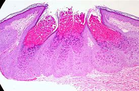 Image result for Molluscum Skin Condition