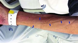 Image result for Bra Indentation Marks On Skin