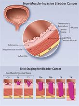 Image result for Sessile Bladder Tumor