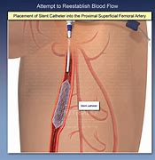 Image result for ICA Stent From Femoral Artery