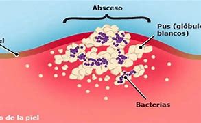 Image result for absceso