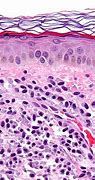 Image result for Molluscum Pathology
