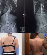 Image result for Severe Scoliosis Before and After