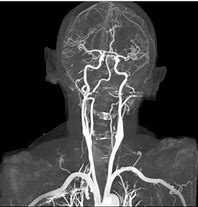 Image result for Carotid Artery CT Scan