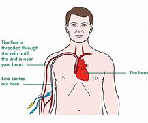 Image result for Double Lumen PICC Line