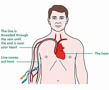 Image result for Arrow PICC Line