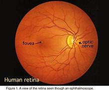 Image result for Retina Optic Disc