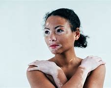 vitiligo 的图像结果