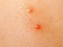 Image result for Molluscum Contagiosum Virus