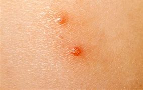 Image result for Severe Molluscum Contagiosum