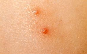 Image result for Pox Virus Molluscum