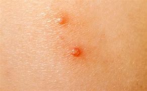 Image result for Molluscum Contagiosum On Stomach