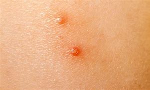 Image result for Molluscum Contagiosum Elbow