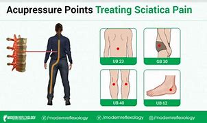 Image result for Acupuncture for Sciatica