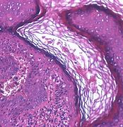 Image result for Squamous Papilloma Eyelid Histology