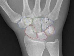 Image result for Scaphoid Pain but No Fracture